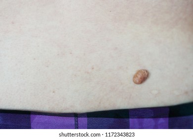 Cutaneous Skin Tag, Tumor At Woman Hip