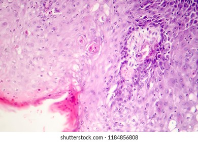 Cutaneous Squamous Cell Carcinoma, Light Micrograph, Photo Under Microscope