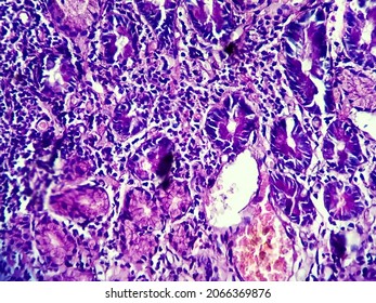 Cutaneous Squamous Cell Carcinoma, Light Micrograph, Photo Under Microscope Showing Typical Keratinous Pearls
