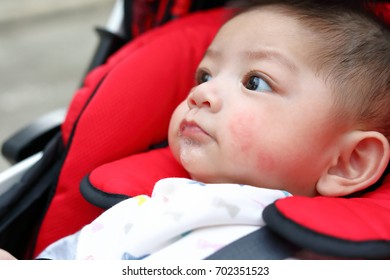 Cute Baby Boy Happy Playful Bubbles Saliva Drool On Child Mouth With Allergic Rash On Kid Chubby Cheeks