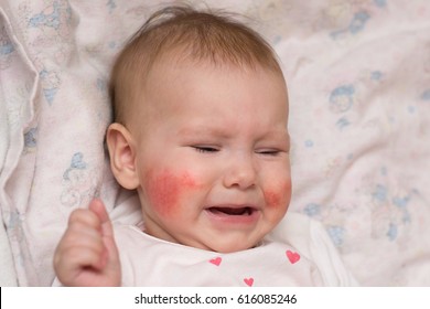 Cute Baby With Eczema On Her Face Crying In Pain