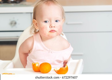 Cute Child Toddler With Food Allergy On Face Eating Mandarins