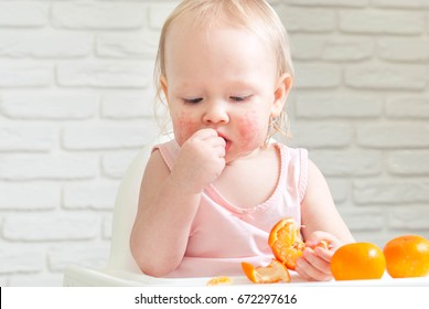 Cute Child Toddler With Food Allergy On Face Eating Mandarins