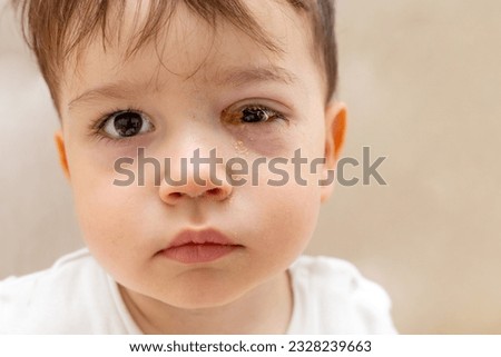 cute infant baby boy with purulent acute bacterial conjunctivitis lying on bed. puffy red eye, virus infection.mother giving eye drops to kid child
