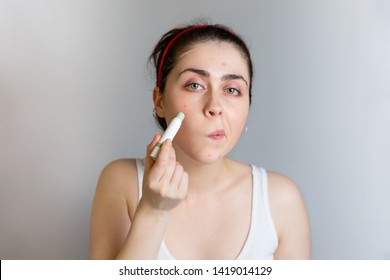 A Cute Teen Girl Uses A Concealer Pencil To Cover Up A Pimple On Her Cheek. The Concept Of Cosmetology And Acne Control, Adolescence. Copy Space