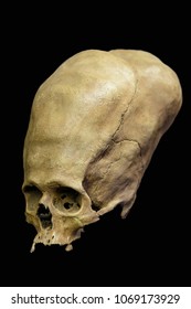 Cuzco / Peru - 07.12.2017: Deformed ancient Peruvian Skull. Rare discovery. 