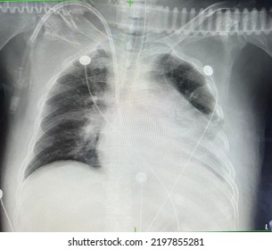 Cxr Lung Patient Pulmonary Edema