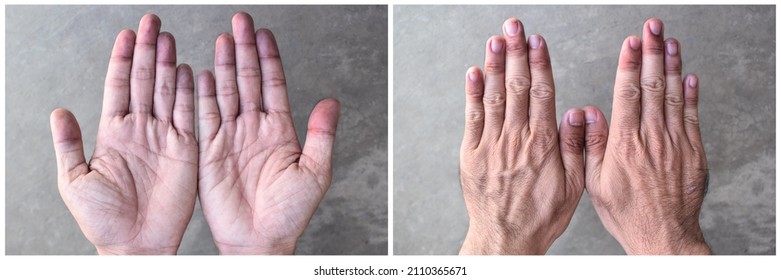 Cyanotic Hands Or Peripheral Cyanosis Or Blue Hands At Southeast Asian, Chinese Man