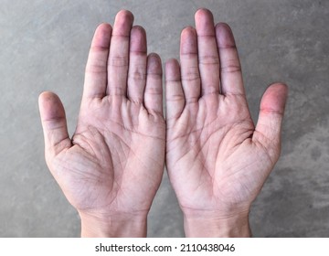 Cyanotic Hands Or Peripheral Cyanosis Or Blue Hands At Southeast Asian, Chinese Man