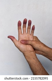 Cyanotic Hands Or Peripheral Cyanosis Or Blue Hands At Southeast Asian, Chinese Old Man