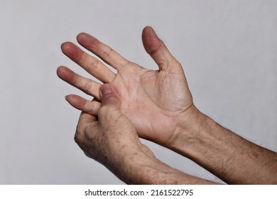 Cyanotic Hands Or Peripheral Cyanosis Or Blue Hands At Southeast Asian, Chinese Old Man