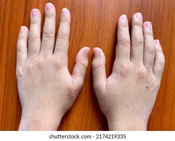 Cyanotic Hands Or Peripheral Cyanosis Or Blue Hands At Southeast Asian, Chinese Child With Congenital Heart Disease.