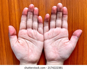 Cyanotic Hands Or Peripheral Cyanosis Or Blue Hands At Southeast Asian, Chinese Child With Congenital Heart Disease.