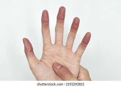 Cyanotic Hands Or Peripheral Cyanosis Or Blue Hands At Southeast Asian, Chinese Young Man