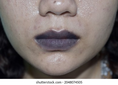 Cyanotic Lips Or Central Cyanosis At Southeast Asian Young Woman With Congenital Heart Disease.