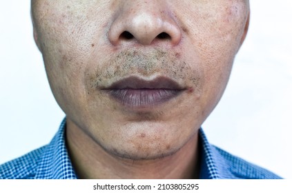 Cyanotic Lips Or Central Cyanosis At Southeast Asian Man With Congenital Heart Disease.