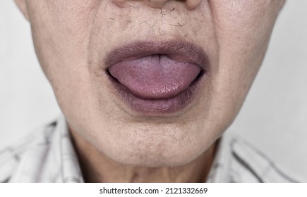 Cyanotic Lips Or Central Cyanosis At Southeast Asian Elder Man With Congenital Heart Disease.