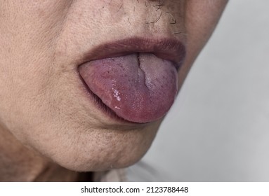 Cyanotic Lips Or Central Cyanosis At Southeast Asian Elder Man With Congenital Heart Disease.