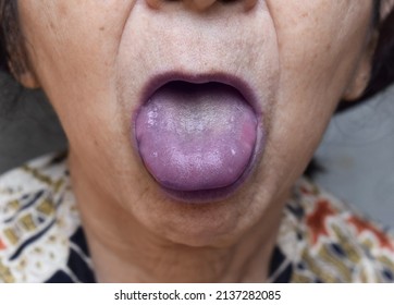 Cyanotic Lips Or Central Cyanosis At Southeast Asian, Chinese Old Woman.