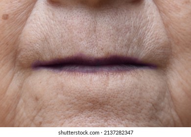 Cyanotic Lips Or Central Cyanosis At Southeast Asian Old Woman