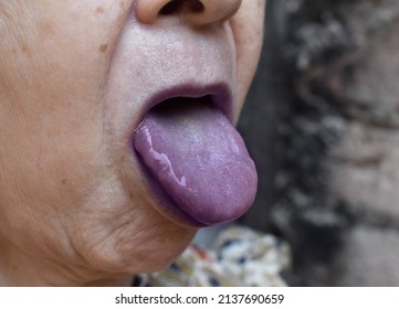 Cyanotic Lips Or Central Cyanosis At Southeast Asian, Chinese Old Woman.