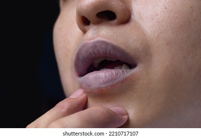 Cyanotic Lips Or Central Cyanosis In Southeast Asian Young Man With Congenital Heart Disease.