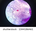 Cyclospora oocyst in Stool ,mAFB. The mature oocyst appears as non-fractile double-walled sphere ,8-10um in diameter. The oocyst contains two sporocysts, each with two sporozoites.