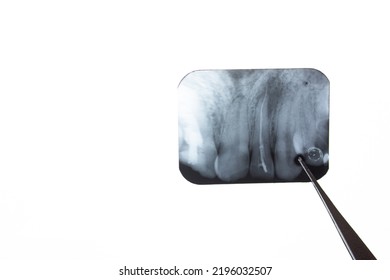 The Cyst X-ray Of The Tooth. Radicular Cyst Of The Upper Jaw. Pathological Formation, A Tumor In The Tooth Is Visible On The X-ray.