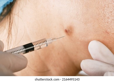 Cystic acne injection treatment, Facial skin problem, Acne disease in adult, Close up woman face with inflammation pimple nodules, Oily greasy face. - Shutterstock ID 2164495143