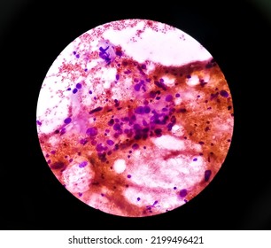 Cytological study of intra abdominal mass: Spindle cell sarcoma, positive for malignant cells. Pleomorphic undifferentiated sarcoma, malignant fibrous histiocytoma. - Shutterstock ID 2199496421