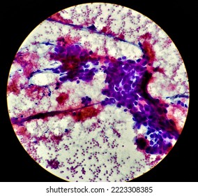 Cytological Study Of Intra Abdominal Mass: Spindle Cell Sarcoma, Positive For Malignant Cells. Pleomorphic Undifferentiated Sarcoma, Malignant Fibrous Histiocytoma