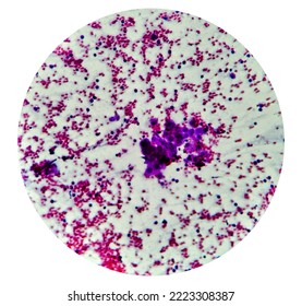 Cytological Study Of Intra Abdominal Mass: Spindle Cell Sarcoma, Positive For Malignant Cells. Pleomorphic Undifferentiated Sarcoma, Malignant Fibrous Histiocytoma