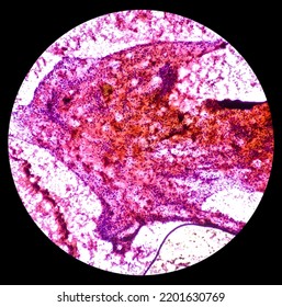 Cytological Study Of Knee Joint Swelling: Spindle Cell Neoplasm, Smear Show Cellular Material Of Oval To Spindle Shaped Cells, Mild Pleomorphism, Blood.