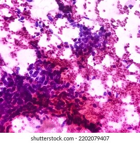 Cytological Study Of Knee Joint Swelling: Spindle Cell Neoplasm, Smear Show Cellular Material Of Oval To Spindle Shaped Cells, Mild Pleomorphism, Blood.