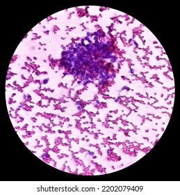 Cytological Study Of Knee Joint Swelling: Spindle Cell Neoplasm, Smear Show Cellular Material Of Oval To Spindle Shaped Cells, Mild Pleomorphism, Blood.