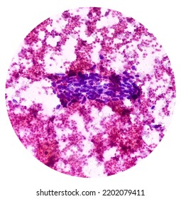 Cytological Study Of Knee Joint Swelling: Spindle Cell Neoplasm, Smear Show Cellular Material Of Oval To Spindle Shaped Cells, Mild Pleomorphism, Blood.