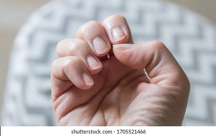 Damaged And Cracked Nails In The Right Hand, Close Up