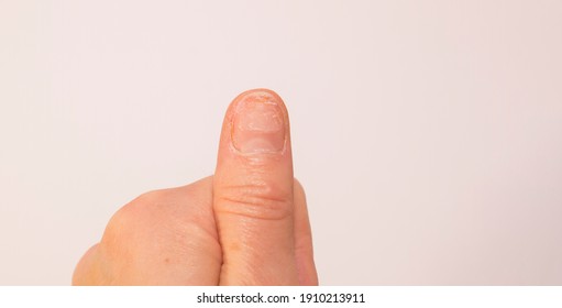 Damaged Fingernails After Removing Gel Nails