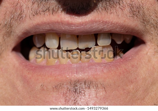 前歯 切れ目 割れ目 詰まりの損傷 悪い大人の男性の前歯の接写 の写真素材 今すぐ編集