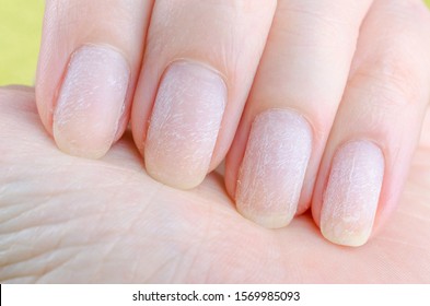 Damaged Nails After Removing Modern Gel Nail Polish