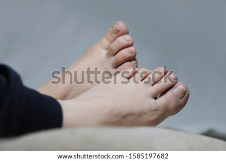 damaged nails of woman's feet