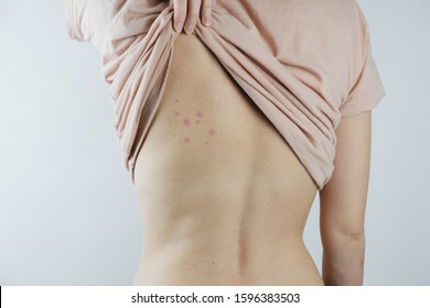 Damaged skin on female's back. Bedbug bites, moosquito bites or skin disease on human body
