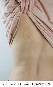 Damaged skin female's back  Bedbug bites  moosquito bites skin disease human body  vertical shot