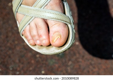 Damaged Toe On The Big Toe. In Shoes. Illness. Fungus.