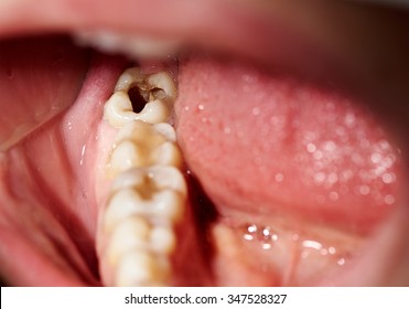 Damaged Tooth With Cavity Dental Caries Decay Disease