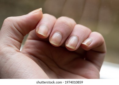 Damaged Yellow Fingernails .
Chipped Nails.