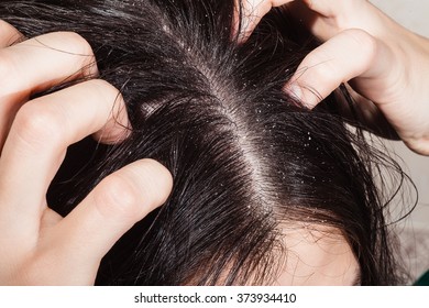 Dander That Causes Itching Scalp