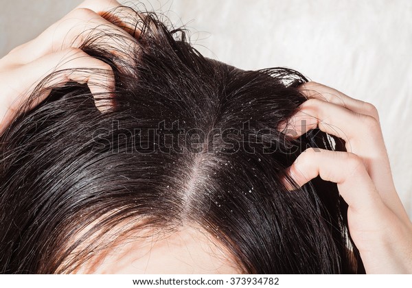 Dander that causes itching\
scalp