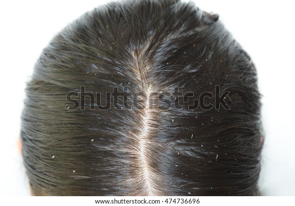 Dandruff Greasy Hair On Head Young Stock Image Download Now