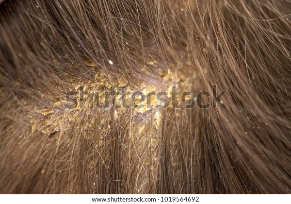 Dandruff in the hair. Flaky scalp. Seborrhea.\
Macro shot. Children\'s dandruff. Seborrheic dermatitis. Scales on\
the scalp and on the hair.\
